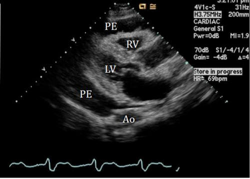 Effusive-Constrictive Pericarditis Secondary to Primary Pericardial ...