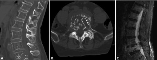 Metastatic Leiomyosarcoma to the Spine Complicated With ...