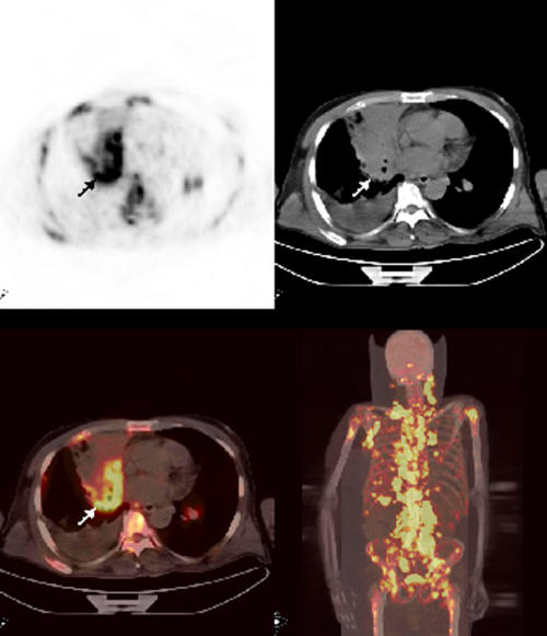 Increasing Role of FDG-PET/CT in Detecting Bone Marrow Metastasis of ...