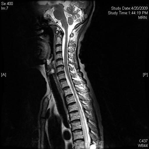 Paraneoplastic Necrotizing Myelopathy in a Patient With Newly Diagnosed ...